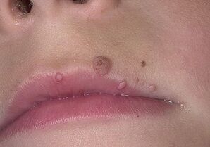 zakaj se na ustnicah pojavijo papilomi