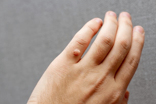 humani papiloma virus na roki