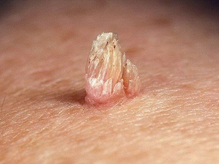 genitalni papiloma na telesu