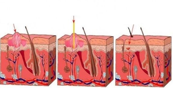 kako laser vpliva na papilome