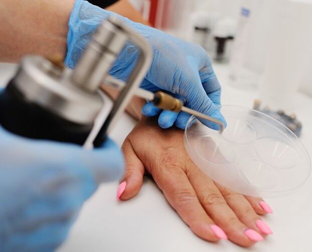 Kriodestrukcija - metoda odstranjevanja bradavic na rokah z zamrzovanjem s tekočim dušikom